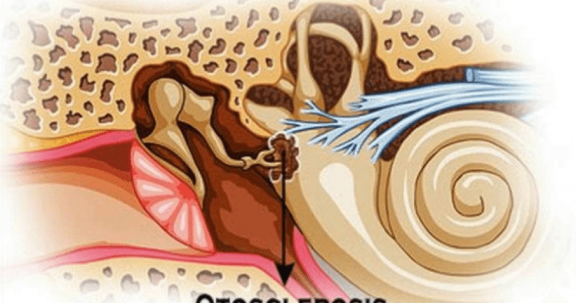 Otosclerose